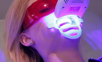 Cần Chuẩn Bị Gì Trước Khi Tẩy Trắng Răng? Bí Quyết Để Đạt Hiệu Quả Tối Ưu