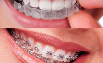 Chỉnh nha và tâm lý học: Nụ cười đẹp giúp bạn thành công?