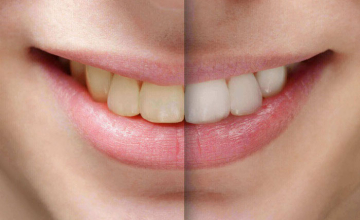 Tẩy Trắng Răng: Không Chỉ Đẹp Mà Còn Tốt Cho Sức Khỏe