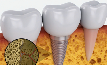 Mối Liên Hệ Giữa Kỹ Thuật Nâng Xương Và Tỷ Lệ Thành Công Của Implant: Phân Tích Từ Chuyên Gia