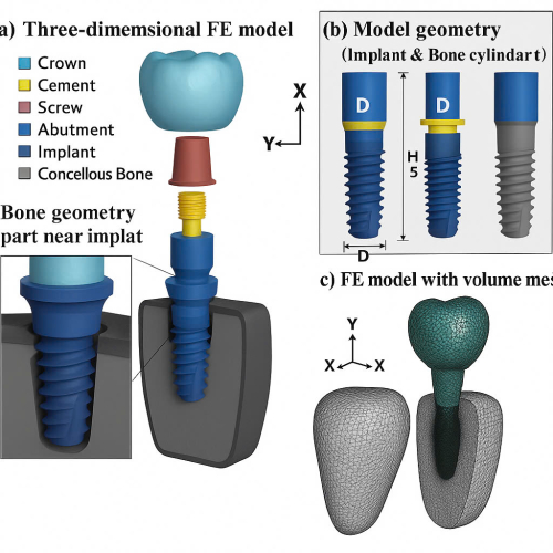  Phân Tích Stress Và Tải Trọng Implant Bằng FEM: Công Nghệ "Nhìn Thấu" Xương Hàm Tại Nha Khoa Smile Hunter