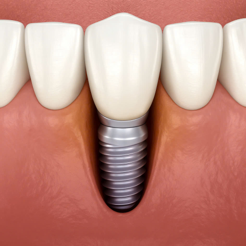 Antibacterial Therapy tại Nha Khoa Smile Hunter: Giảm 90% Biến Chứng Viêm Nhiễm Implant